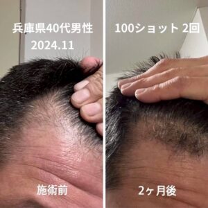 V字の生え際・薄毛悩みに！産毛が育つ環境を整える頭皮ケア